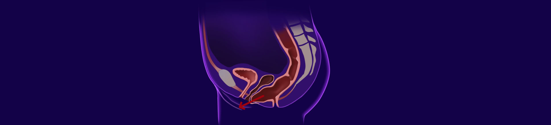 Chirurgie des troubles de la statique rectale 
